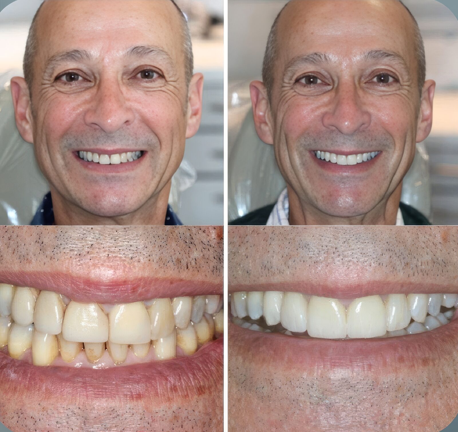 Before and after photographs of a patient treated at Desert Oral Surgery